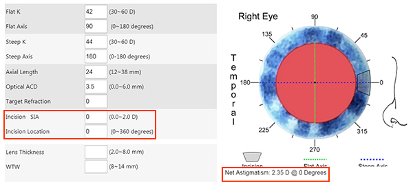 bigsia-clculo-del-astigmatismo-corneal-inducido-por